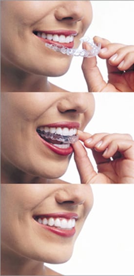 Three vertical nose-to-chin photos of a woman smiling. In the top photo she is holding the top Invisalign aligner close to her mouth. In the second photo she is placing the aligner on her teeth. The third photo shows how the clear aligners look on her teeth.