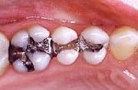 Before photo of five lower teeth, including molars, for information on Hoffman Estates mercury-free dentistry from Dr. William Becker.