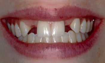 Close-up photo of a woman's mouth. She is smiling and both lateral incisors are missing, before she received a dental bridge made of porcelain crowns.
