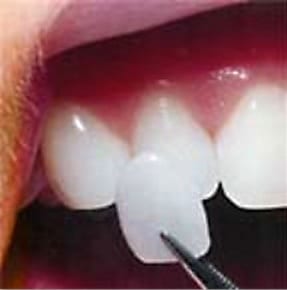 a single porcelain veneer being bonded onto a tooth