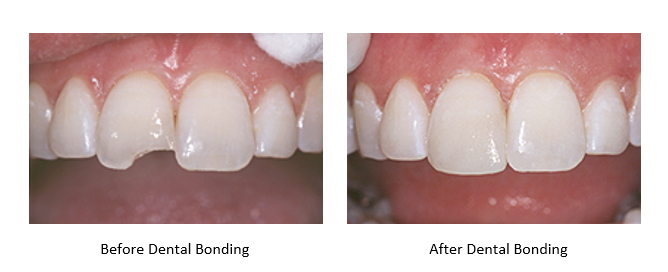 Before and after a chipped tooth repaired with dental bonding