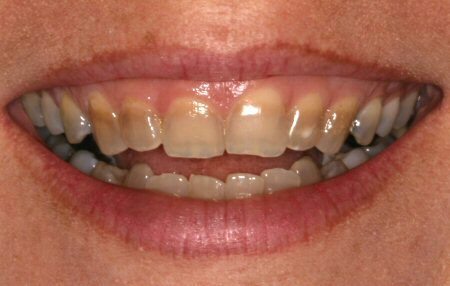 tetracycline stained teeth