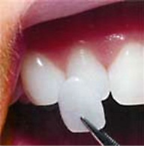 Porcelain veneer being held up to a tooth
