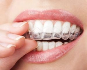 Invisalign with teeth whitening gel