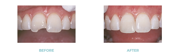 before and after a dental bonding procedure