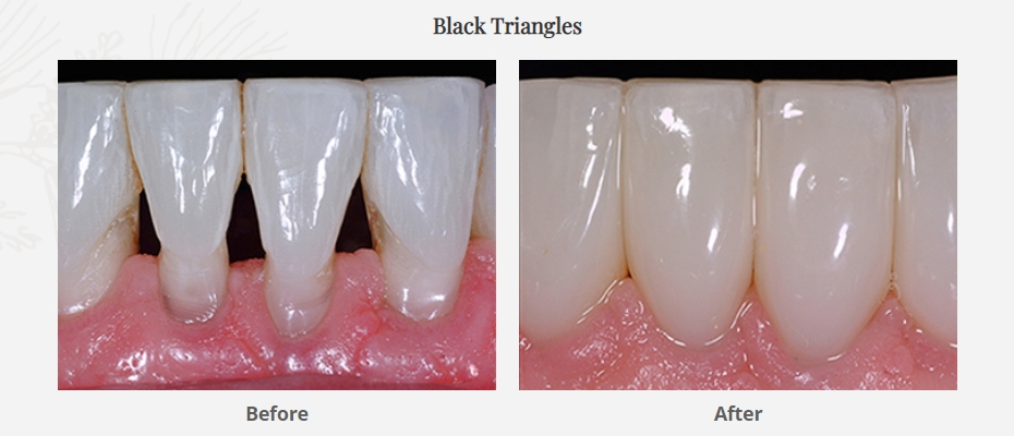 Black triangles repaired with dental bonding