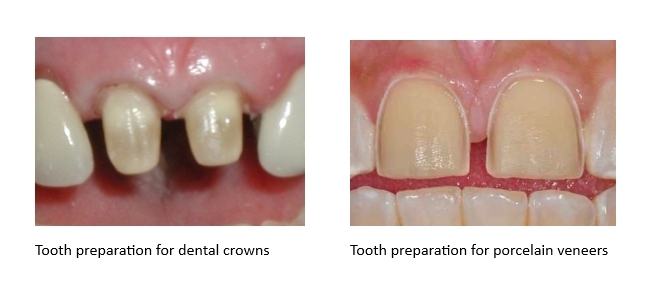 A side by side image of tooth preparation for dental crowns versus porcelain veneers