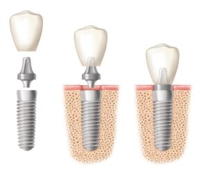 An illustration of a dental implant in three images